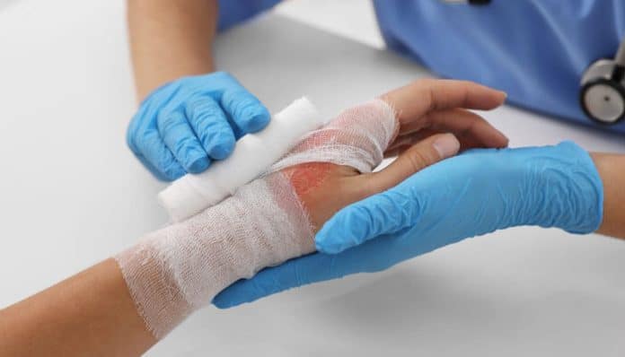 A medical professional dressing a patient’s bandaged hand with visible burn marks, illustrating treatment in Burn Injury Cases.