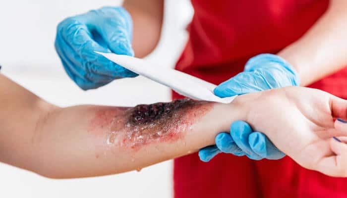 Why a New Jersey Burn Injury Lawyer Matters