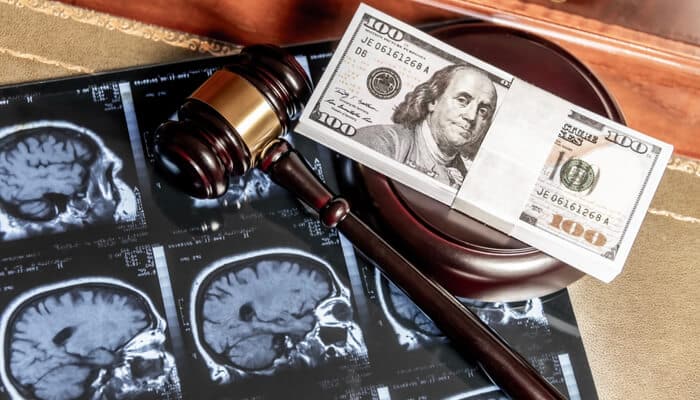 Traumatic Brain Injury Settlement of Nearly Million - Mylegalopinion 1 - My Legal Opinion Bailey and Galyen Law Firm personal injury settlement concept showing brain injury scans, gavel, and compensation money
