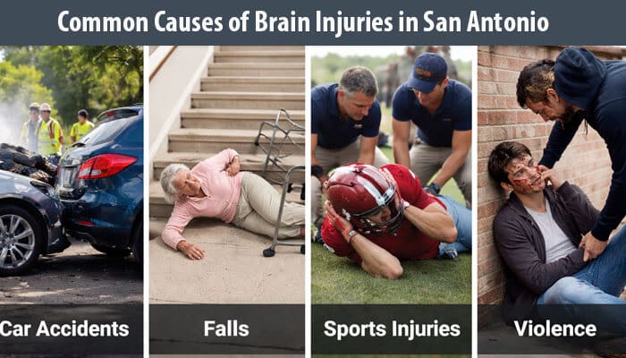 Common Causes of Brain Injuries in San Antonio - My Legal Opinion - My Legal Opinion Common causes of brain injuries in San Antonio: Car accidents, falls, sports injuries, and violence, all leading to traumatic brain injuries.